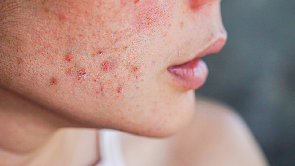 functional medicine approach to acne-2